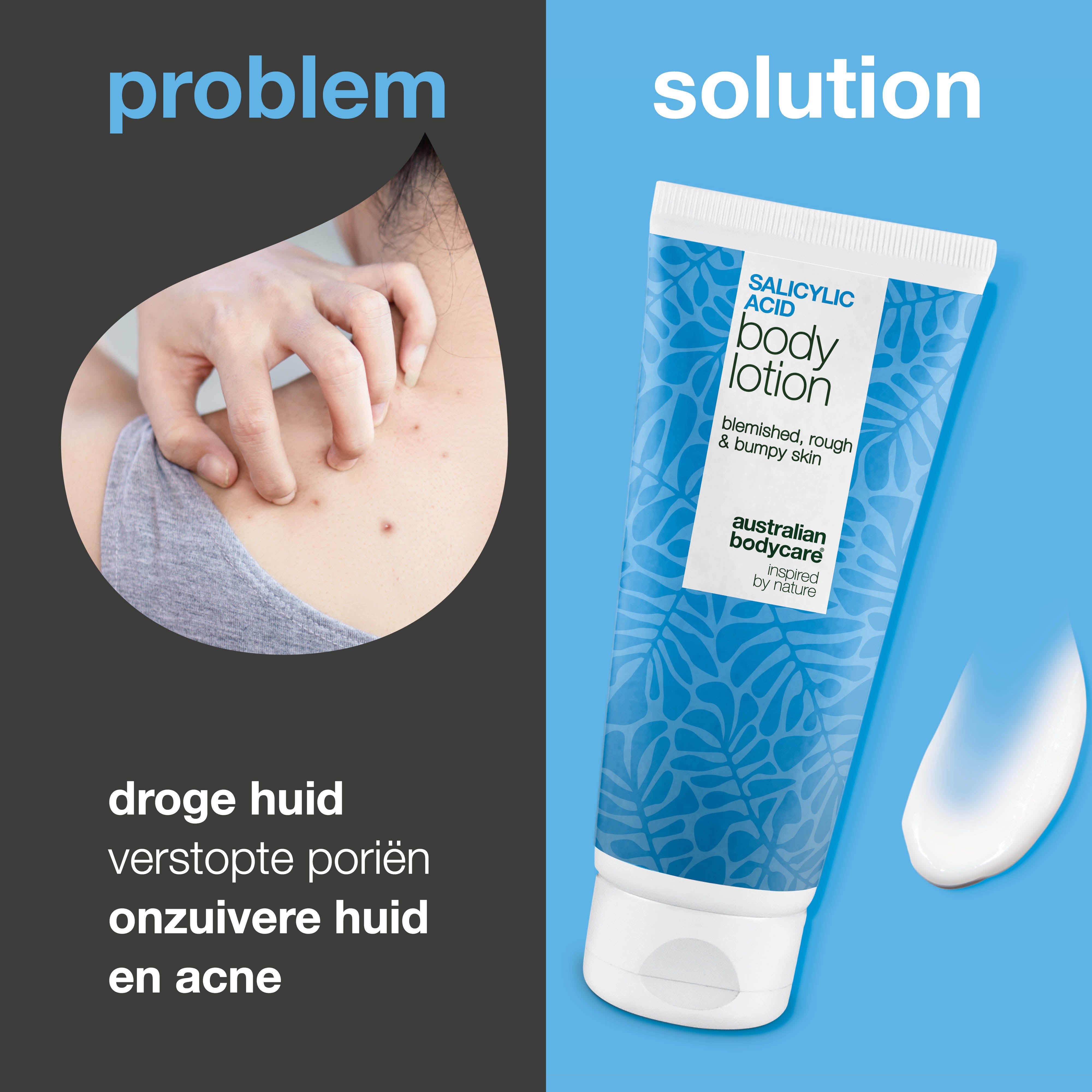 Body Lotion met salicylzuur – tegen onzuiverheden en droge huid —  Body Lotion met salicylzuur exfolieert, hydrateert en helpt bij onzuiverheden, ruwe en droge huid. Perfect voor dagelijks gebruik.