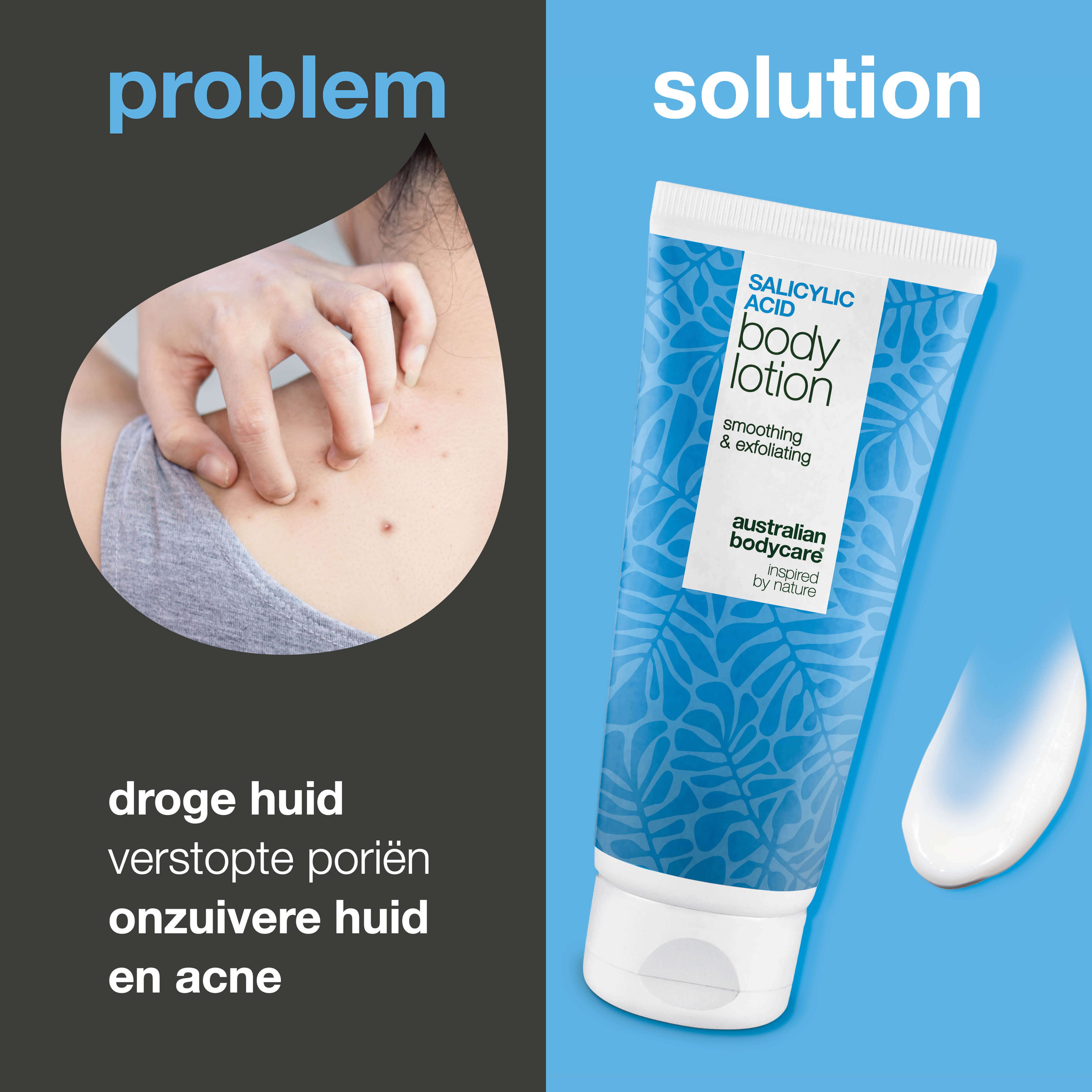 Keratosis Pilaris Bodylotion verzacht ruwe, droge huid en bultjes. Voor dagelijks gebruik. Met salicylzuur, niacinamide en zinc PCA.