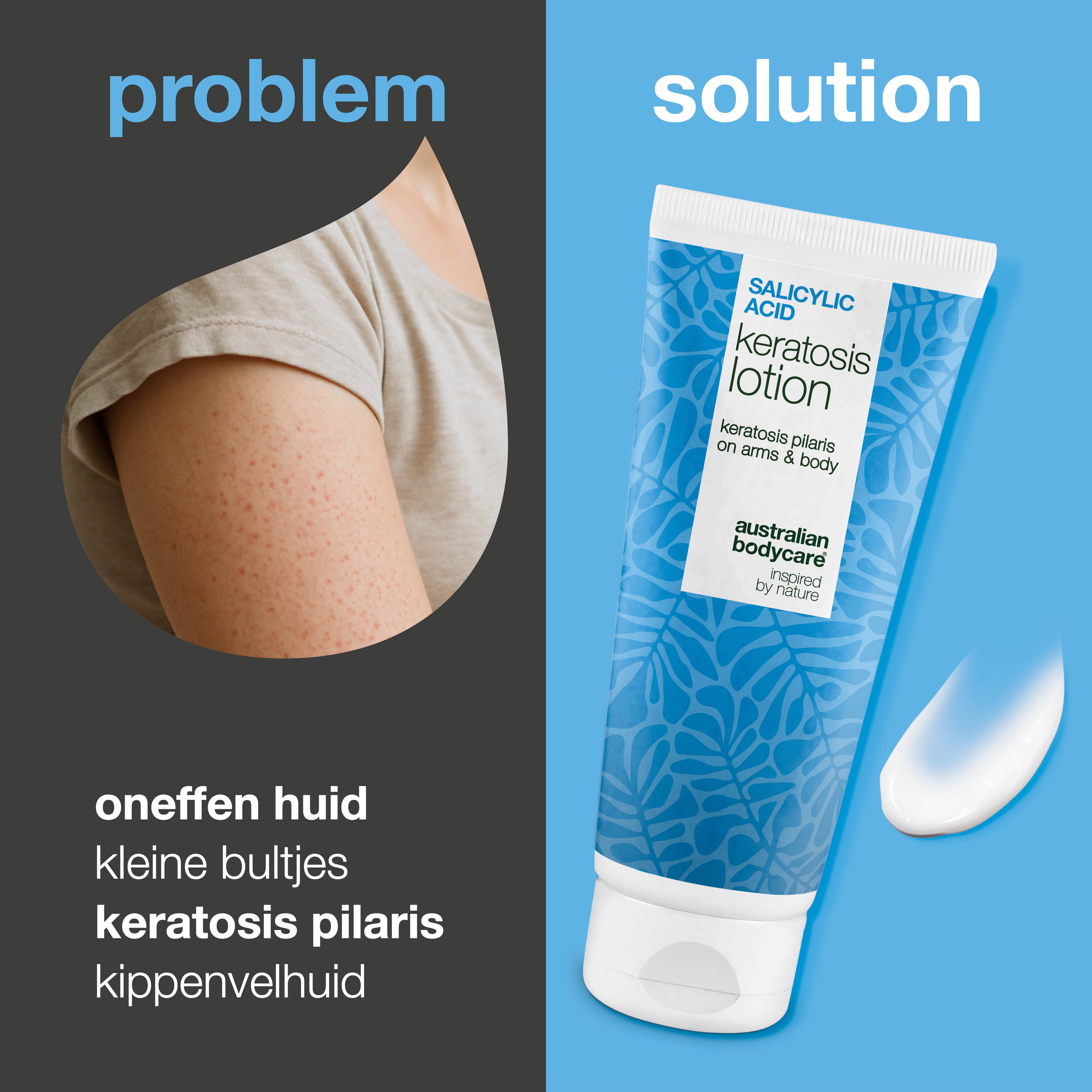 Body lotion bij keratosis pilaris en ruwe, bobbelige huid — Body lotion voor keratosis pilaris en droge huid. Verzacht met salicylzuur, niacinamide en zink.