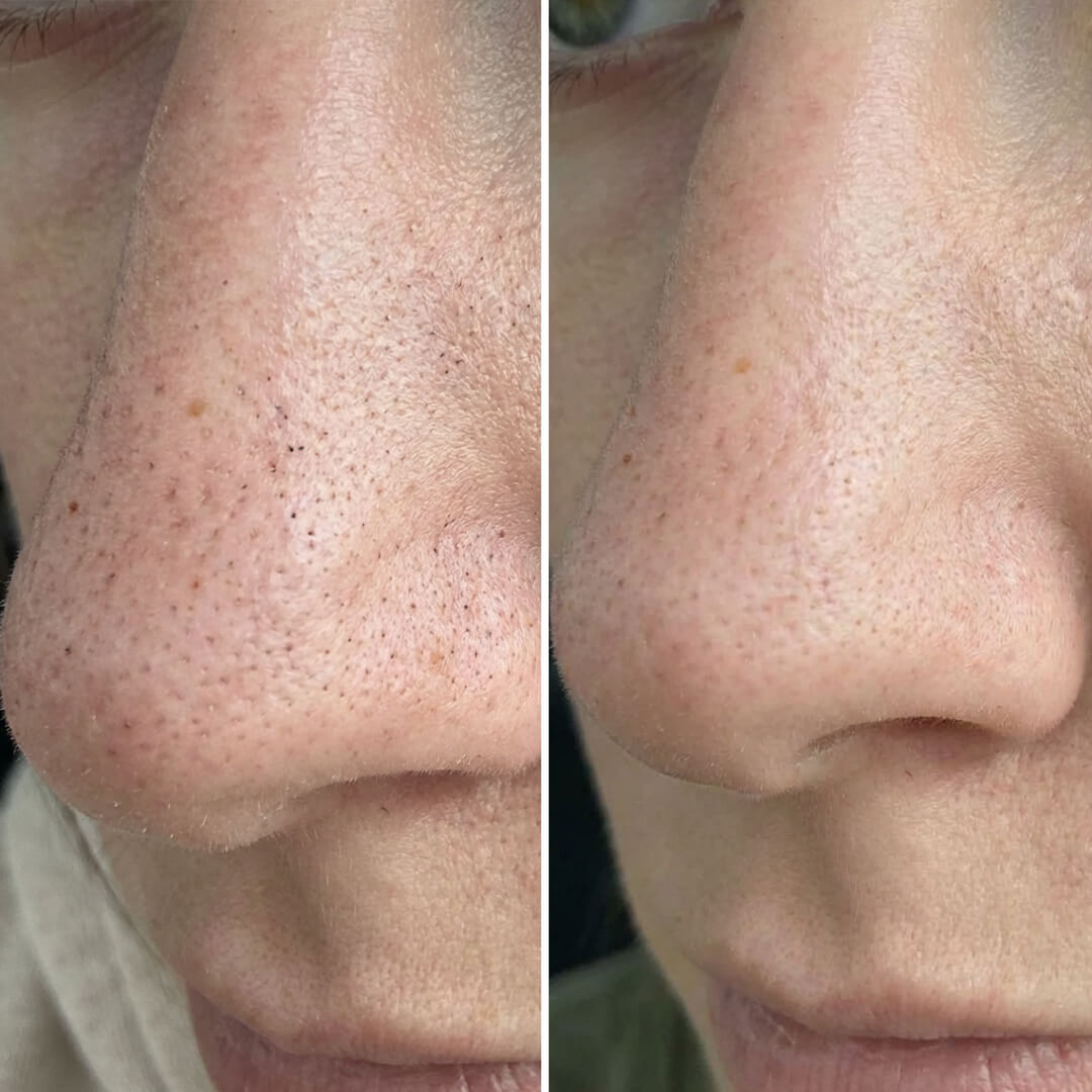 Set tegen mee-eters en verstopte poriën met salicylzuur – diep reinigende routine voor een gladde huid