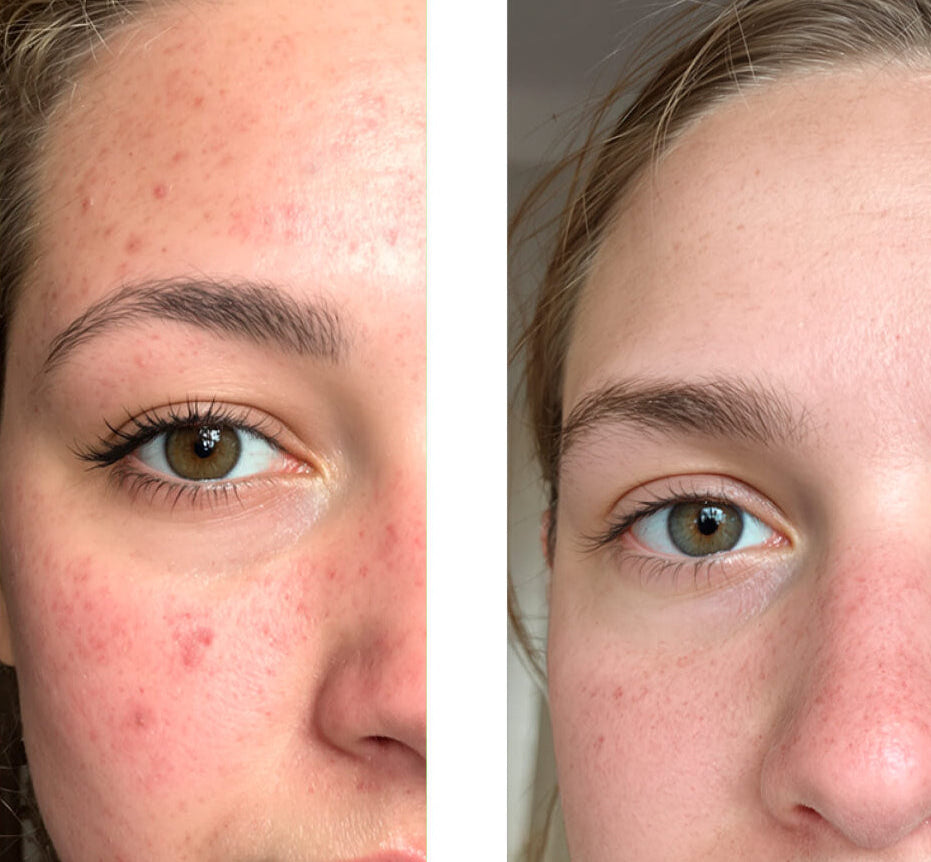 Voor/na foto van een klant die onze 2% Salicylic Acid Face Toner/Peeling/Exfoliant gebruikt, met grote verbetering van de huid en minder puistjes en onzuiverheden.