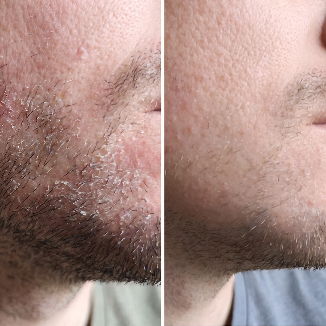 Salicylzuur Serum – Tegen roos in gezicht, baard en wenkbrauwen — Effectief serum tegen roos in het gezicht en de baard. Salicylzuur verwijdert schilfers en roodheid snel voor een gezonde huidbalans.