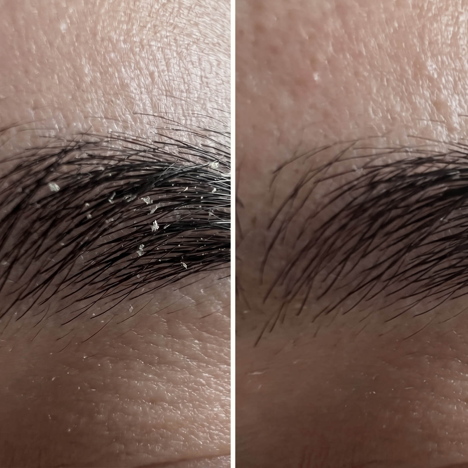 Salicylzuur Serum – Tegen roos in gezicht, baard en wenkbrauwen — Effectief serum tegen roos in het gezicht en de baard. Salicylzuur verwijdert schilfers en roodheid snel voor een gezonde huidbalans.