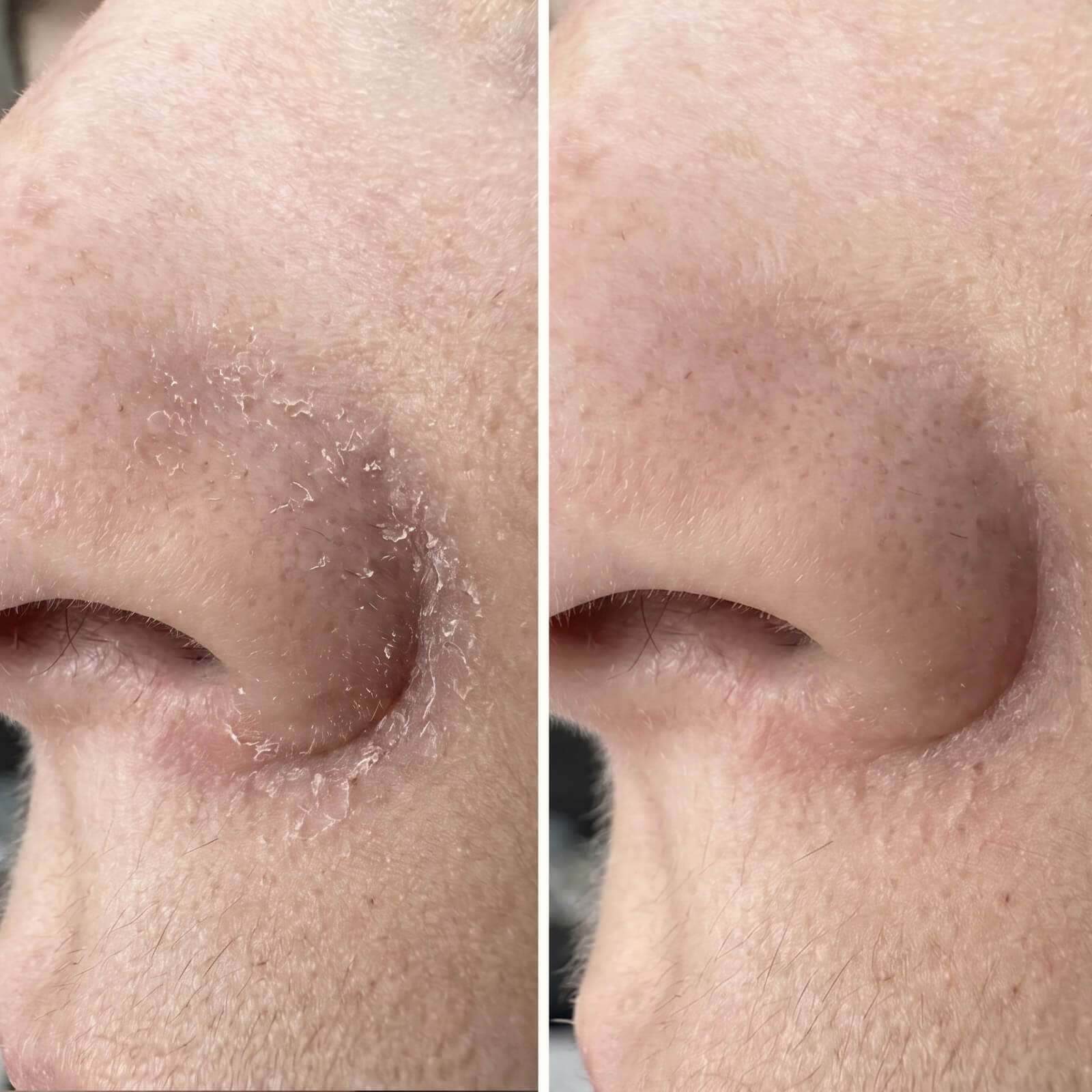 Salicylzuur Serum – Tegen roos in gezicht, baard en wenkbrauwen — Effectief serum tegen roos in het gezicht en de baard. Salicylzuur verwijdert schilfers en roodheid snel voor een gezonde huidbalans.