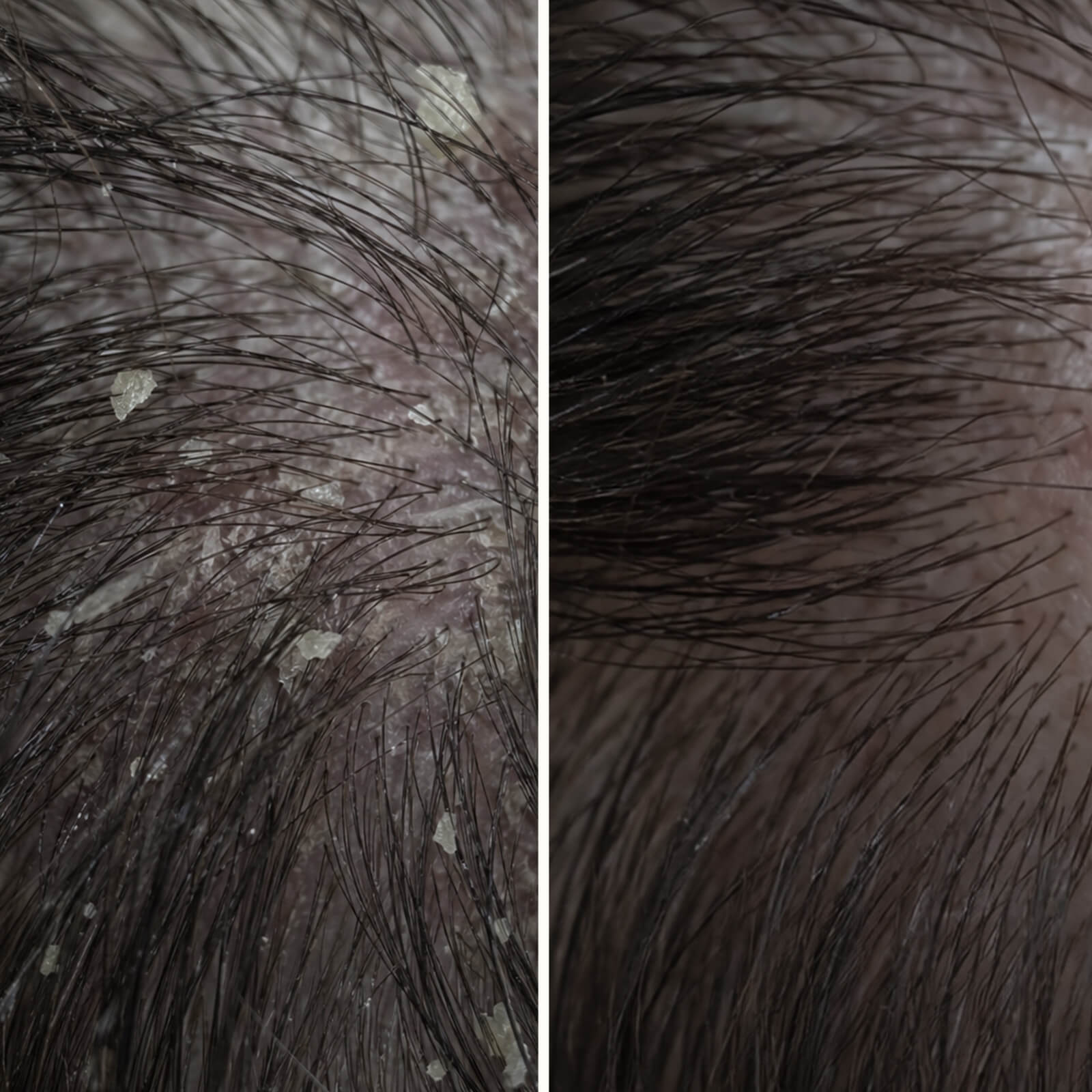 Salicylzuur hoofdhuidbehandeling tegen jeuk en schilfers — Salicylzuur hoofdhuidbehandeling verlicht jeuk, schilfers en vet. Gebruik voor het wassen voor diepe exfoliatie met actief salicylzuur.