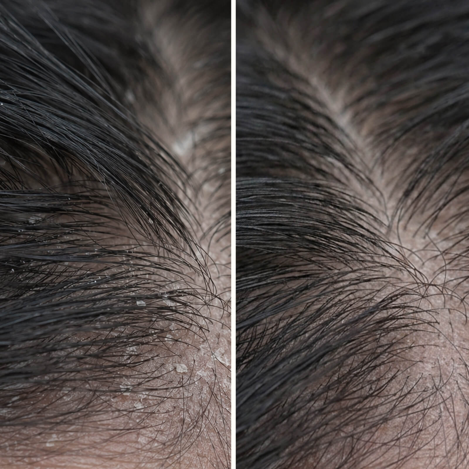 Salicylzuur hoofdhuidbehandeling tegen jeuk en schilfers — Salicylzuur hoofdhuidbehandeling verlicht jeuk, schilfers en vet. Gebruik voor het wassen voor diepe exfoliatie met actief salicylzuur.