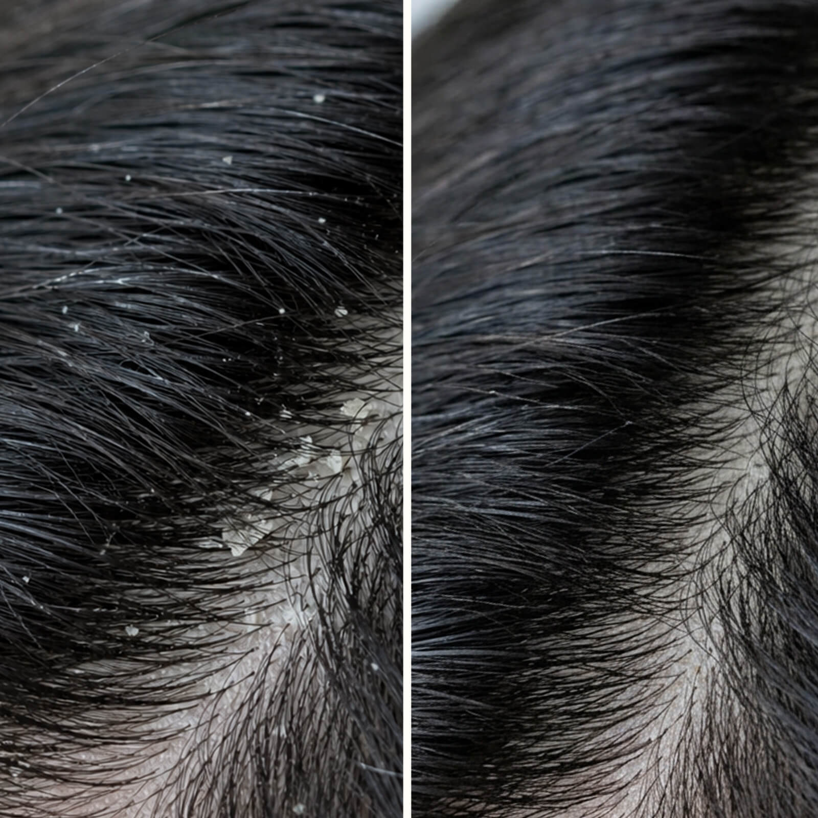 Salicylzuur Shampoo tegen roos, jeuk en droge hoofdhuid — Stop een jeukende hoofdhuid en roos met deze shampoo. Kalmeert de droge huid en verwijdert dode huidcellen met salicylzuur.