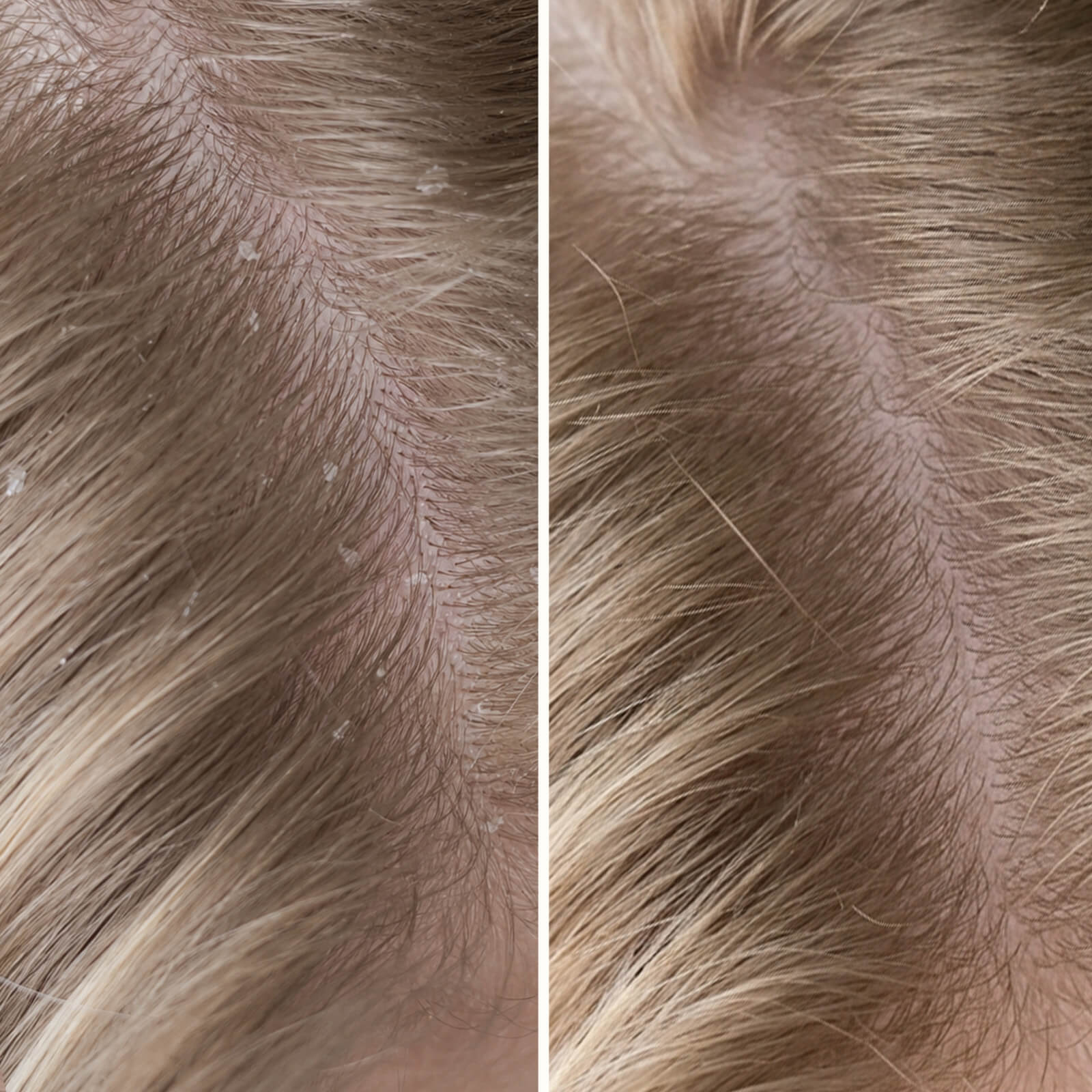 Salicylzuur Shampoo tegen roos, jeuk en droge hoofdhuid — Stop een jeukende hoofdhuid en roos met deze shampoo. Kalmeert de droge huid en verwijdert dode huidcellen met salicylzuur.