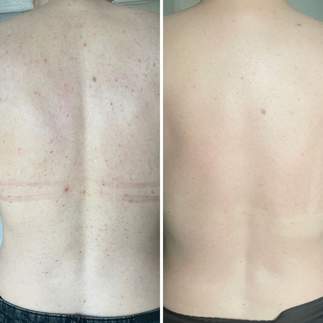 Voor-en-na-afbeelding van een rug met zichtbare puistjes en acne op de ‘voor’-foto, en een heldere, gladde rug zonder onzuiverheden na 4 weken consequent gebruik van Australian Bodycare Salicylzuur Body Spray.