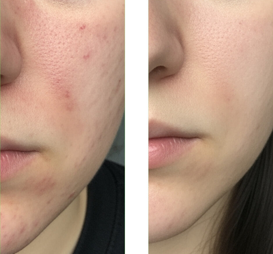 Voor/na foto van een klant die onze Salicylic Acid Cleanser gebruikt, met grote verbetering van de huid en minder puistjes en onzuiverheden.
