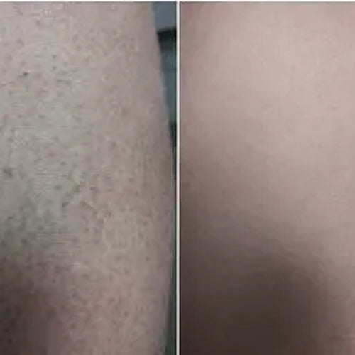 Resultaat van Alena na 2 weken met het keratosis pilaris behandelingsset
