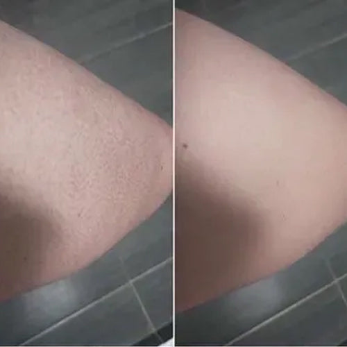 Keratosis pilaris voor en na – gladdere huid van Alena na 2 weken