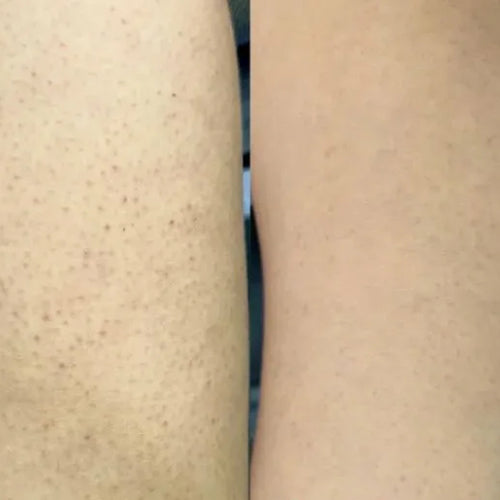 Resultaat van Isabell met het keratosis pilaris set – minder bultjes op de dijen