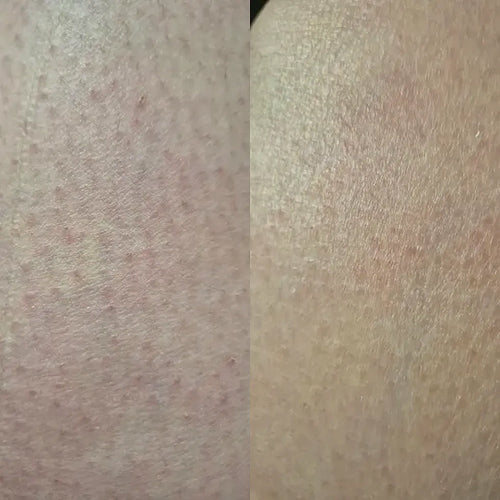 Close-up van de huid na keratosis pilaris behandeling – resultaat van Carolin