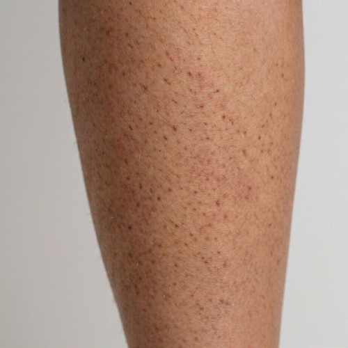 Close-up van keratosis pilaris – kleine ruwe bultjes op de armen