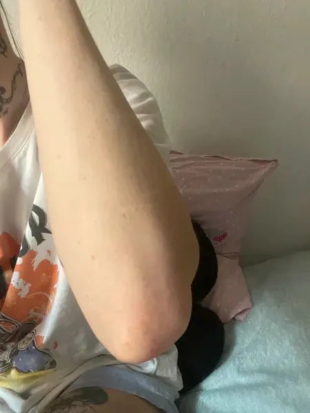 Klantresultaat keratosis pilaris – Lisa A.
