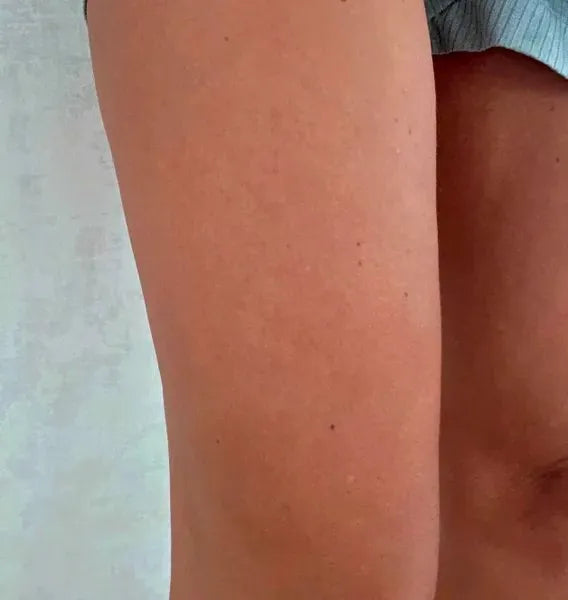 Klantresultaat keratosis pilaris – Sarah S.