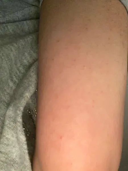 Klantresultaat keratosis pilaris – Shaian H. gebruikt Australian Bodycare