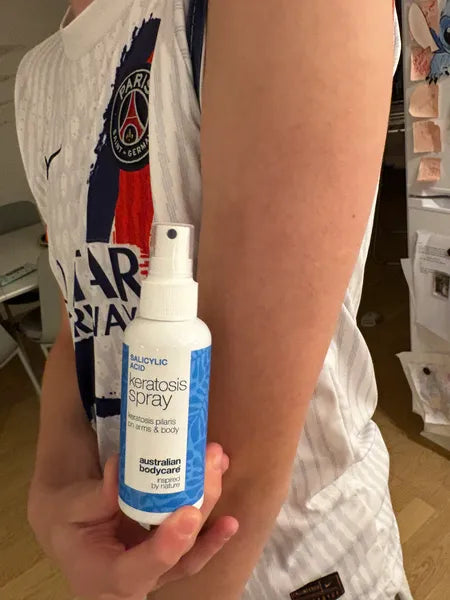 Klantresultaat keratosis pilaris – 70% minder bultjes na 3 weken