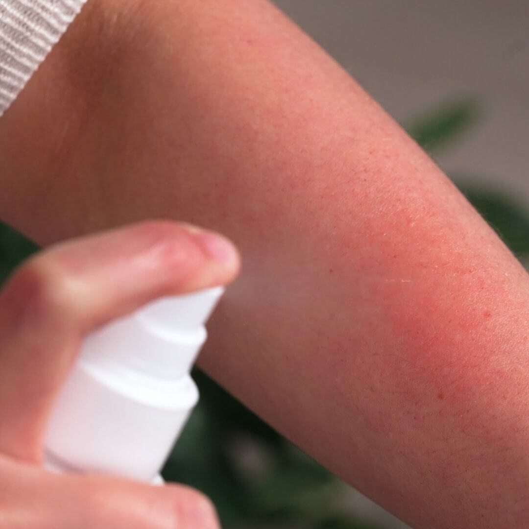 Spray bij een jeukerig gevoel - Verzachtende en kalmerende anti–jeuk spray voor de droge huid