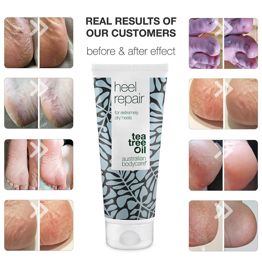 Hielkloven Crème met 25% Ureum — Intensieve hielcrème voor droge hielen en hielkloven